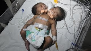 Two Headed Baby Conjoined Twin Boys In India [upl. by Atteve]