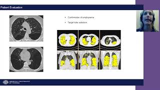 Patient Evaluation for Zephyr Endobronchial Valve Treatment [upl. by Leummas337]