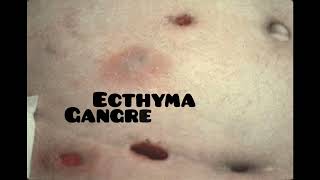 ecthyma causes symptoms and treatment dermatologyskin disease [upl. by Llydnek]