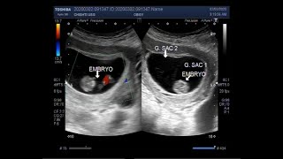 Ultrasound Video showing Vanishing twin syndrome with one normal fetus alongside a blighted ovum [upl. by Adnilem]