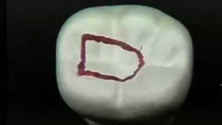 Endodontic Cavity Preparation  Phase I  Posterior [upl. by Also]