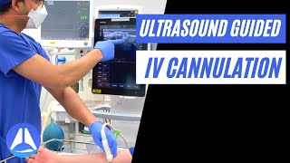 Intravenous IV Cannulation under Ultrasound US guidance  5 steps to optimise your view [upl. by Dunson]