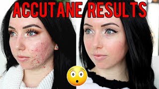 MY ACCUTANE JOURNEY 6 MONTH RESULTS Before amp After Side Effects Would I Do it Again [upl. by Annayehc]