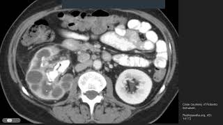 XGP xanthogranulomatous pyelonephritis [upl. by Euqinobe833]