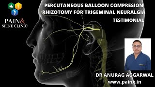 BALLOON COMPRESSION RHIZOTOMY trigeminal neuralgia treatment [upl. by Zeralda]