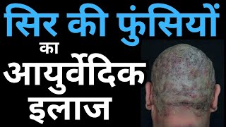 Ayurvedic Treatment for Scalp Folliculitis Causes amp Home Remedies [upl. by Hillell]