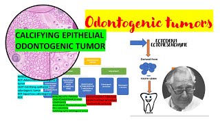 Calcifying epithelial odontogenic tumor CEOTDETAILEDPindborg tumor Tumors of odontogenic origin [upl. by Agem864]