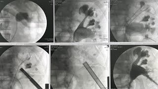 PCNL of staghorn renal stone [upl. by Caitlin]