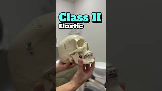 Class II Elastic Mechanics orthodontics dental melvindentalcare [upl. by Fredric923]