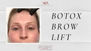 Treating BOTOX BROW LIFT with Botox  Skin Perfect Walnut Medical Spa Clinic [upl. by Oicanata]