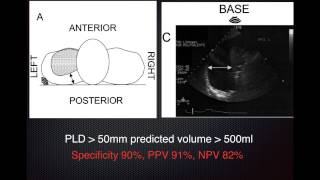 Estimate Pleural Effusion Volume [upl. by Orravan128]