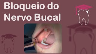 Bloqueio do Nervo Bucal [upl. by Suckow]