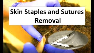 How To Remove Skin Staples and Sutures [upl. by Simmonds]