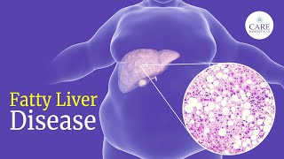 How Dangerous can be Fatty Liver  Fatty Liver Symptoms Causes and Treatment amp Prevention [upl. by Laughry]