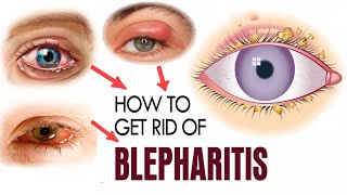 How to Treat Blepharitis at Home  Home Remedies for Blepharitis Treatment [upl. by Nike603]