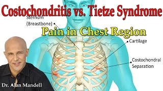 Costochondritis vs Tietzes Syndrome Pain in Chest Region  Dr Mandell [upl. by Darra353]