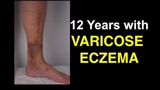 12 Years With Varicose Eczema  Shocking Lessons [upl. by Ahsele]