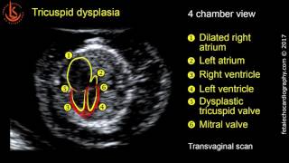 Fetal echocardiography at 1113 weeks Tricuspid Valve Dysplasia with Severe Tricuspid Regurgitation [upl. by Sheena]