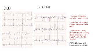 Left Ventricular Hypertrophy OR MYOCARDIAL INFARCTION I ECG CASE SCENARIO [upl. by Otha]