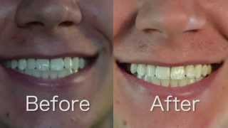 Using Crest 3D Whitestrips in 2022 Honest Review  How to Whiten Yellow Teeth [upl. by Edalb]