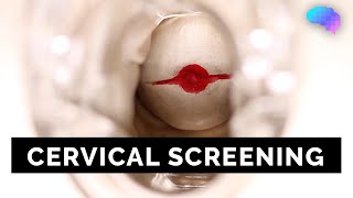 Cervical Screening SMEAR  OSCE Guide  UKMLA  CPSA [upl. by Belsky]