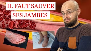 ARTÈRES des jambes BOUCHÉES et ULCÈRE de la PEAU ce quil faut savoir [upl. by Erusaert]