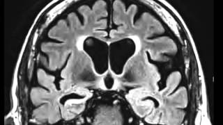 Mesial Temporal Sclerosis [upl. by Onileba]