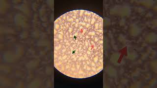 Blood smear examinationneutrophils and lymphocytesamp absolute lymphopenia observed on DLC evaluati [upl. by Valenba]