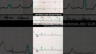 Left bundle branch block LBBB ECG Broad R waves in leftsides leads [upl. by Angeli]