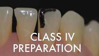 Class IV Preparation for Resin Composite [upl. by Nat621]