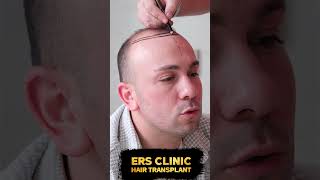 Hair transplantation requires experience hairtransplant sacekimi hair [upl. by Llenrahs]