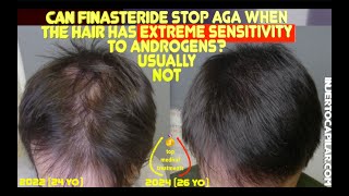 Short term 2 yrs Can finasteride stop AGA when the hair has extreme sensitivity to androgens2022 [upl. by Yajnas]