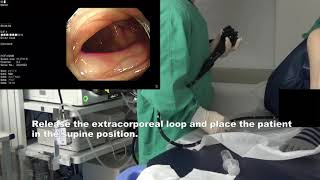 Total colonoscopy  tight Sigmoid colon [upl. by Feriga]