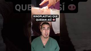 Se OPERAN la NARIZ y quedan PEOR 🐽  Esta RINOPLASTIA le cambió hasta los LABIOS [upl. by Nyltac317]