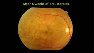 AIOC2018  IC484  Topic  Central Chorioretinitis  Retinochoroiditis  DrMallika Goyal [upl. by Metabel]