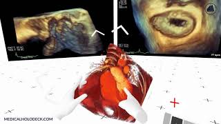 Ultrasound and Angiography Import to Virtual Reality [upl. by Lucas]