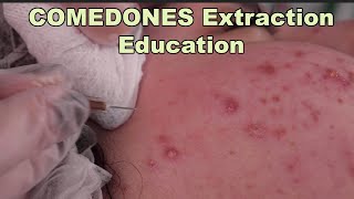 Comedones Extraction Part 1 of the best acne treatment before and after pictures included [upl. by Graehl]