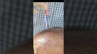 PRGF PRP  Mesotherapy amp Microneedling for Hair Regrowth amp Thickening Dr Shaheen Aesthetics Isb [upl. by Yelnats]