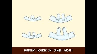 Comment insérer une canule nasale [upl. by Rimas]