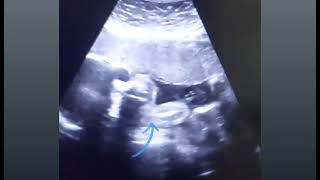 Anterior placenta with 28 weeks baby movements gender amp 3VCord  8 weeks pregnancy with heartbeat [upl. by Alison]