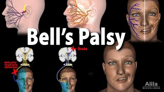 Bells Palsy Pathophysiology Symptoms Diagnosis and Treatment Animation [upl. by Juline718]