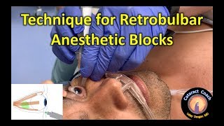 Technique for Retrobulbar Anesthetic Injection for Eye Surgery [upl. by Yud]