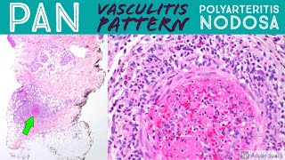 Polyarteritis nodosa amp leukocytoclastic vasculitis pattern Inflammatory Dermpath Basics [upl. by Ansela]