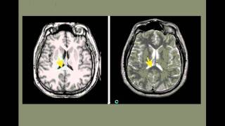 Neuroanatomia por imagenes [upl. by Digdirb]