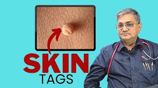 Painless skin tags remove in just 10 minutes  how to get rid of skin tags  skin tags remove [upl. by Catlee]