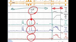 how to interpret cystometry urodynamics [upl. by Jeaz361]