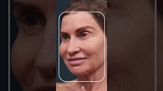 CO2 Laser Resurfacing  Facial Rejuvenation [upl. by Claire]