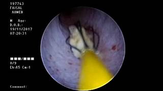 URS for Impacted Intramural Ureteric Stone DrAlAdimi [upl. by Kroo]