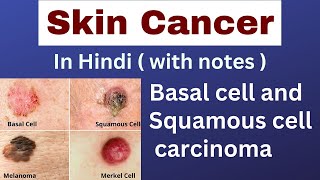 Skin cancer  Squamous cell carcinoma  Basal cell carcinoma  nursing lecture in hindi  msn [upl. by Anrev]