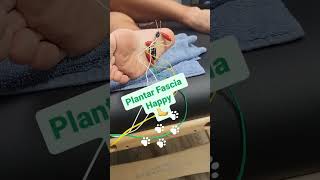 Plantar Fascia Dry Needling Treatment [upl. by Tuchman]